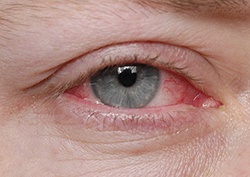 Patient with pink eye in need of treatment