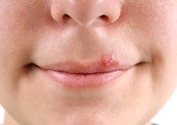 Online Cold Sore Treatment - Virtual Doctor - MD Anywhere