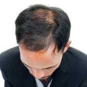 Picture of balding man searching for Hairloss prevention