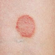 ringworm rash