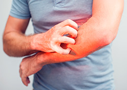 Online Scabies Prevention - Online Permethrin Treatment