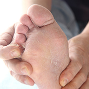 A man checks the dry, peeling skin of the athletes foot fungus between his toes.