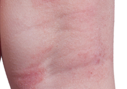 Online Eczema Treatment - Online Atopic Dermatitis Treatment
