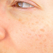 Woman with dark spots on face