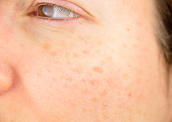 Online Dark Spot Reducer - Online Hydroquinone Prescription